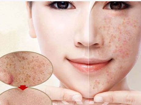 激光祛斑和光子祛斑哪个比较好,液态祛斑和激光祛斑哪个效果更好