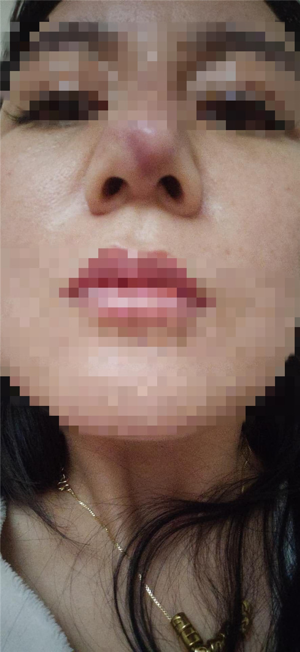 女子居民楼里整容结果成畸形：想死的心都有，老公现在见我就烦