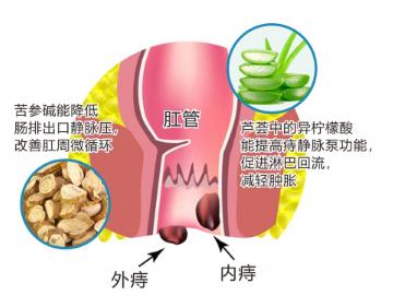 得了痔疮怎么办学会三招治痔疮,得了痔疮别担心这个小方法快试试