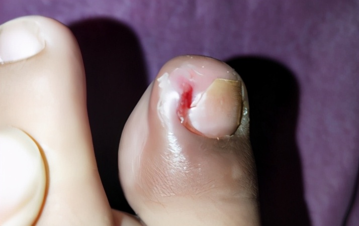 脚趾甲甲根处嵌甲怎么治疗,脚趾甲老往肉里长是缺什么吗