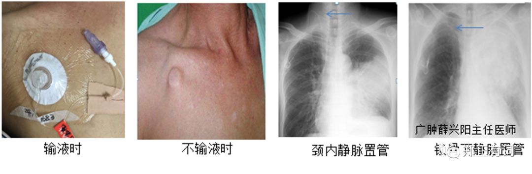 静脉输液港植入是治疗什么病的,静脉输液港植入术