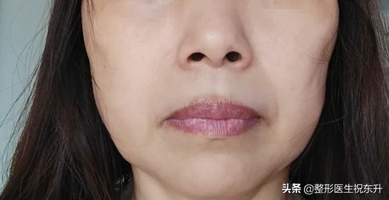 为什么打完瘦脸针脸会凹陷,刚刚打完瘦脸针一侧有鼓包怎么办