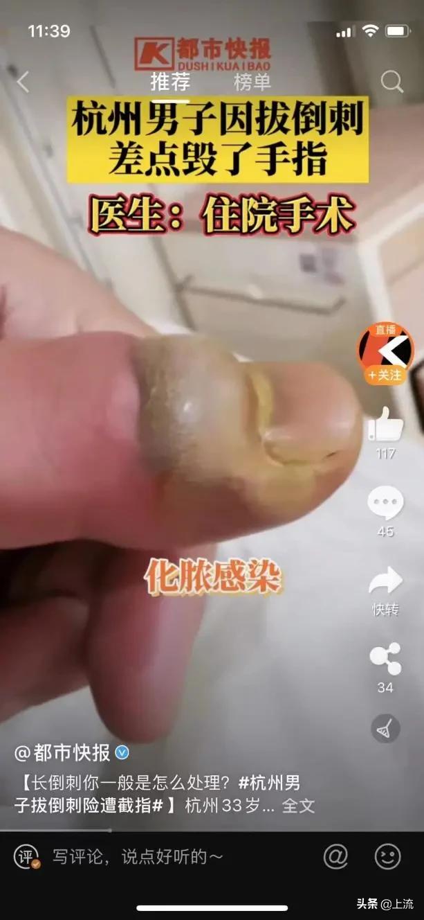 为什么总是忍不住拔倒刺,为什么会忍不住撕倒刺