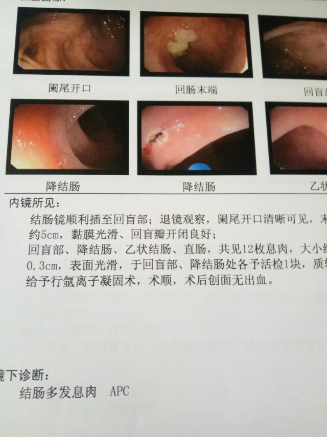 胃镜显示十二指肠溃疡疤痕,十二指肠溃疡疤痕能消除吗