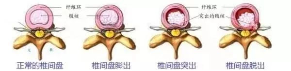 中西医结合治疗脊椎病，个性化定制治疗方案