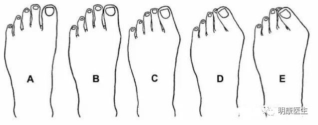 拇外翻治疗视频大全,治疗拇外翻最好医院