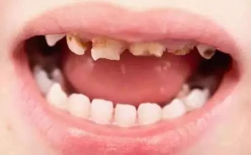 一岁孩子门牙奶瓶龋怎么办,两岁宝宝牙齿有奶瓶龋