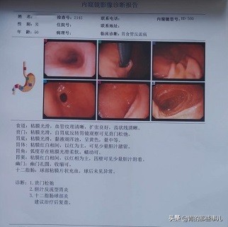 24小时烧心反酸喉咙烧灼怎么办,20年反流性食管炎