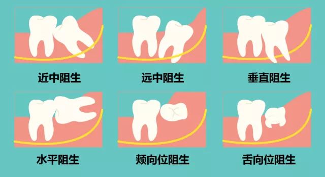 拔智齿术前麻醉后遗症,拔智齿前的流程及注意事项