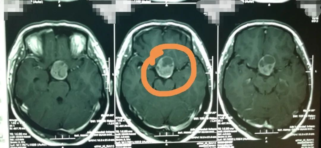 想怀孕二胎怀不上怎么办,怀不上孩子跟垂体瘤有关吗