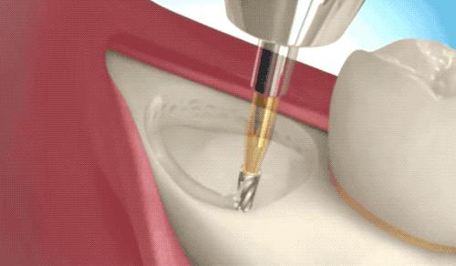 拔了一颗智齿花了1300元贵吗,拔个智齿花了800