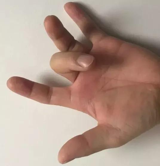 手指头伸不开一伸就疼,请问医生我手痛手指麻是什么原因