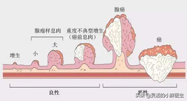 结肠息肉会转癌症吗,结肠息肉属良性肿瘤能变癌吗