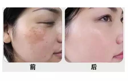 光子嫩肤alma,光子嫩肤alp