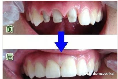 牙齿掉了镶哪种假牙比较好,牙齿缺失多用什么义齿好