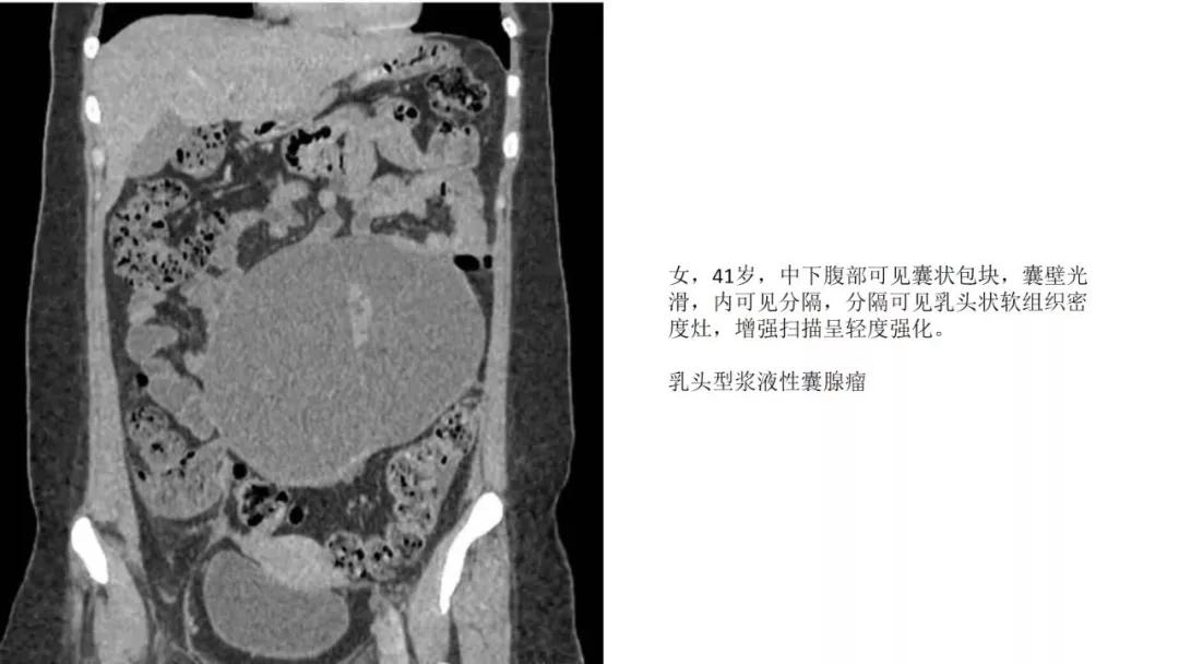卵巢原发肿瘤的分析思路