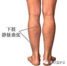 简述大隐静脉曲张治疗方法,大隐静脉曲张分期