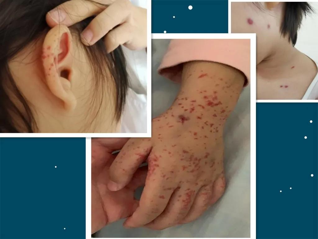 被臭蚊子叮咬起红包怎么治疗,被蚊子叮咬起了很大的红包