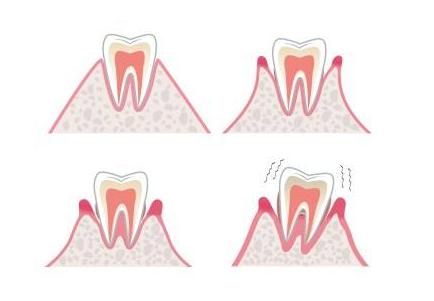 刚刚做完牙齿矫正需要注意什么,牙齿矫正结束后的注意事项