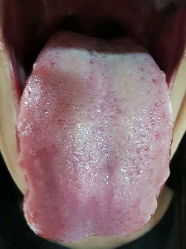 子宫内膜薄咽炎乳腺增生结节,鼻咽炎睡眠呼吸暂停综合征