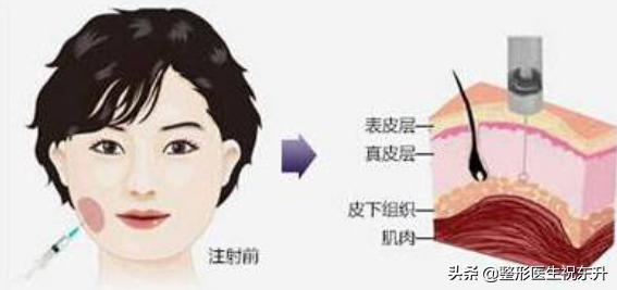 为什么打完瘦脸针脸会凹陷,刚刚打完瘦脸针一侧有鼓包怎么办