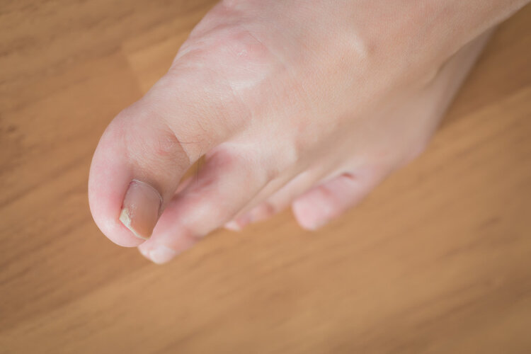 得了甲沟炎有什么注意事项,甲沟炎不是很严重时应该怎么办