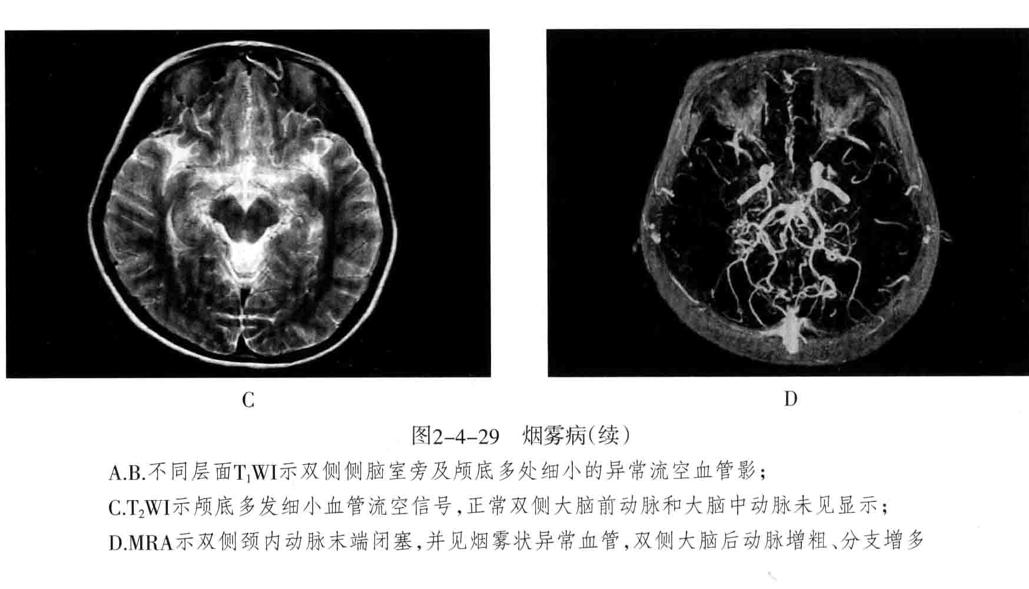颅内血管轻度狭窄诊断标准,颅内血管先天变异影像