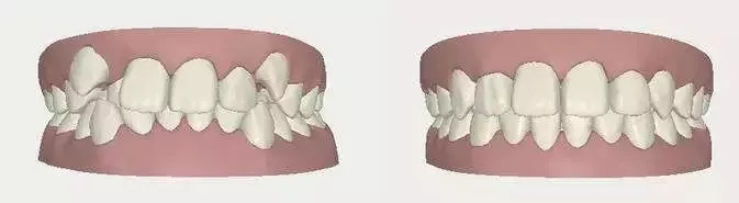 虎牙齿能不能拔,老虎牙可以拔掉吗