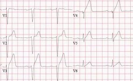 常见心梗特殊心电图,各部位心梗心电图详解