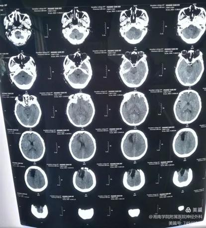 微血管减压术治疗面肌痉挛康复,面肌痉挛显微血管减压术一次解决