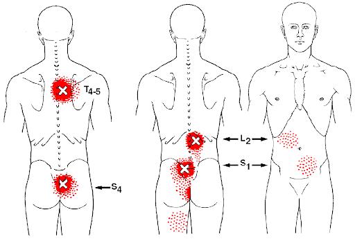 腰背部僵硬做什么运动,腰突恢复期感觉背部肌肉紧绷僵硬