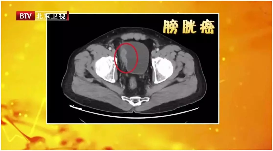 膀胱癌症状无痛血尿,膀胱癌血尿为什么是无痛间歇性