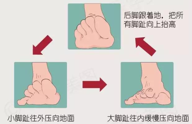 中老年女性拇外翻能矫正过来吗,女性脚拇指外翻原因