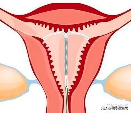 节育器能百分百避免怀孕吗,节育器能百分百防止怀孕么