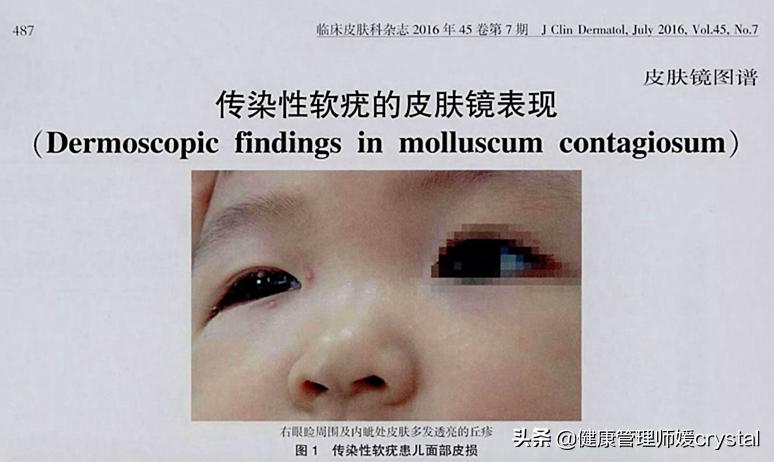 幼儿如何防止皮肤病,小孩皮肤病的预防