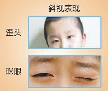 家长担心小孩近视加深,孩子近视会引起斜视吗