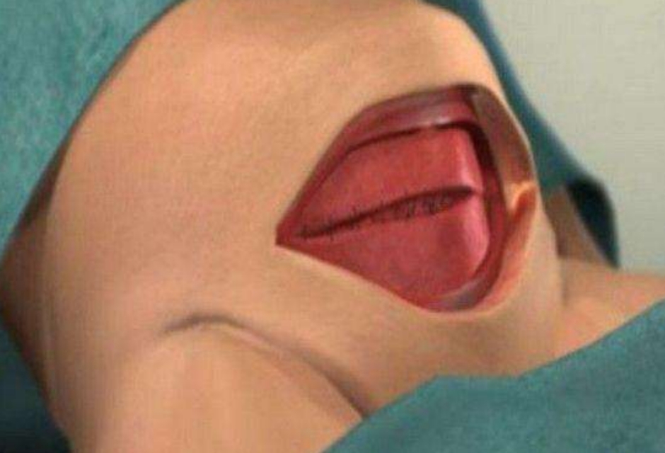 一分钟了解剖宫产视频,30秒了解剖宫产