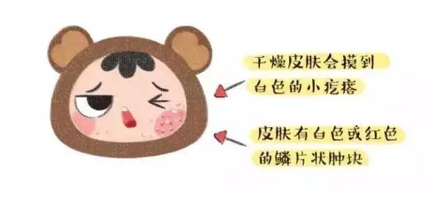 宝宝湿疹总不好怎么回事,宝宝湿疹一直不好是怎么回事