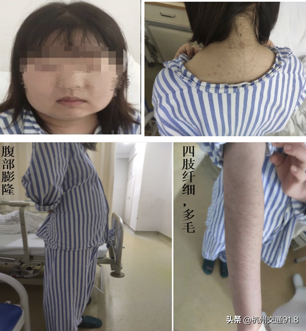 17岁女生长小胡子正常吗,18岁女生突然长小胡子