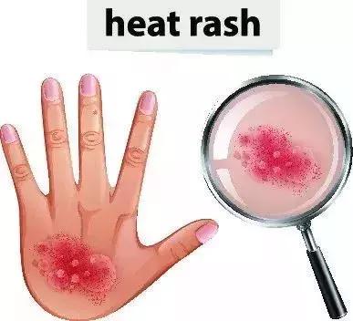 宝宝湿疹分类及表现简答,宝宝湿疹这4点要记住