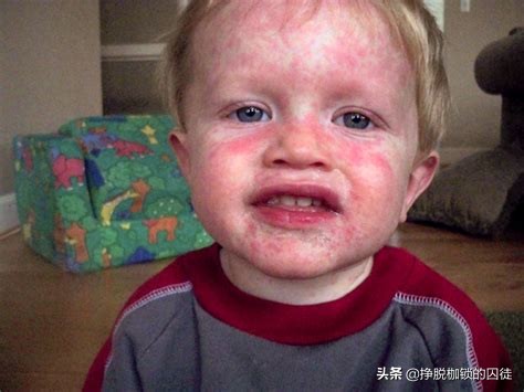 青霉素过敏后果很严重吗,青霉素过敏严重会怎么样