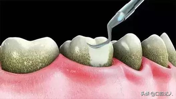 洗牙过后牙齿特别敏感,洗牙之后牙敏感喝水刷牙都凉