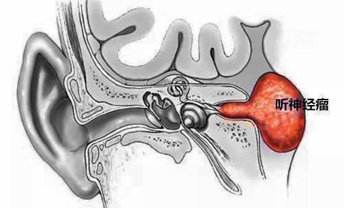 长了听神经瘤可以做微创手术吗？手术风险大吗？