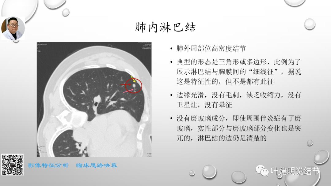 叶建明谈肺实性小结节视频,廖正银教授谈肺结节