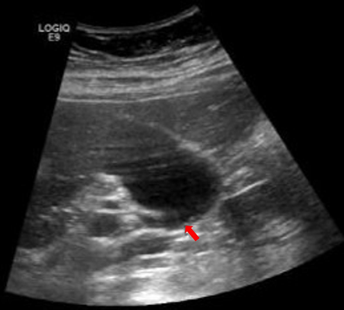 空腹做彩超能检查出什么,彩超为什么检查肝要空腹