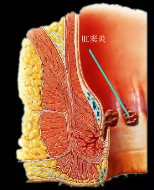 复杂肛瘘是什么原因引起的,肛瘘痛苦