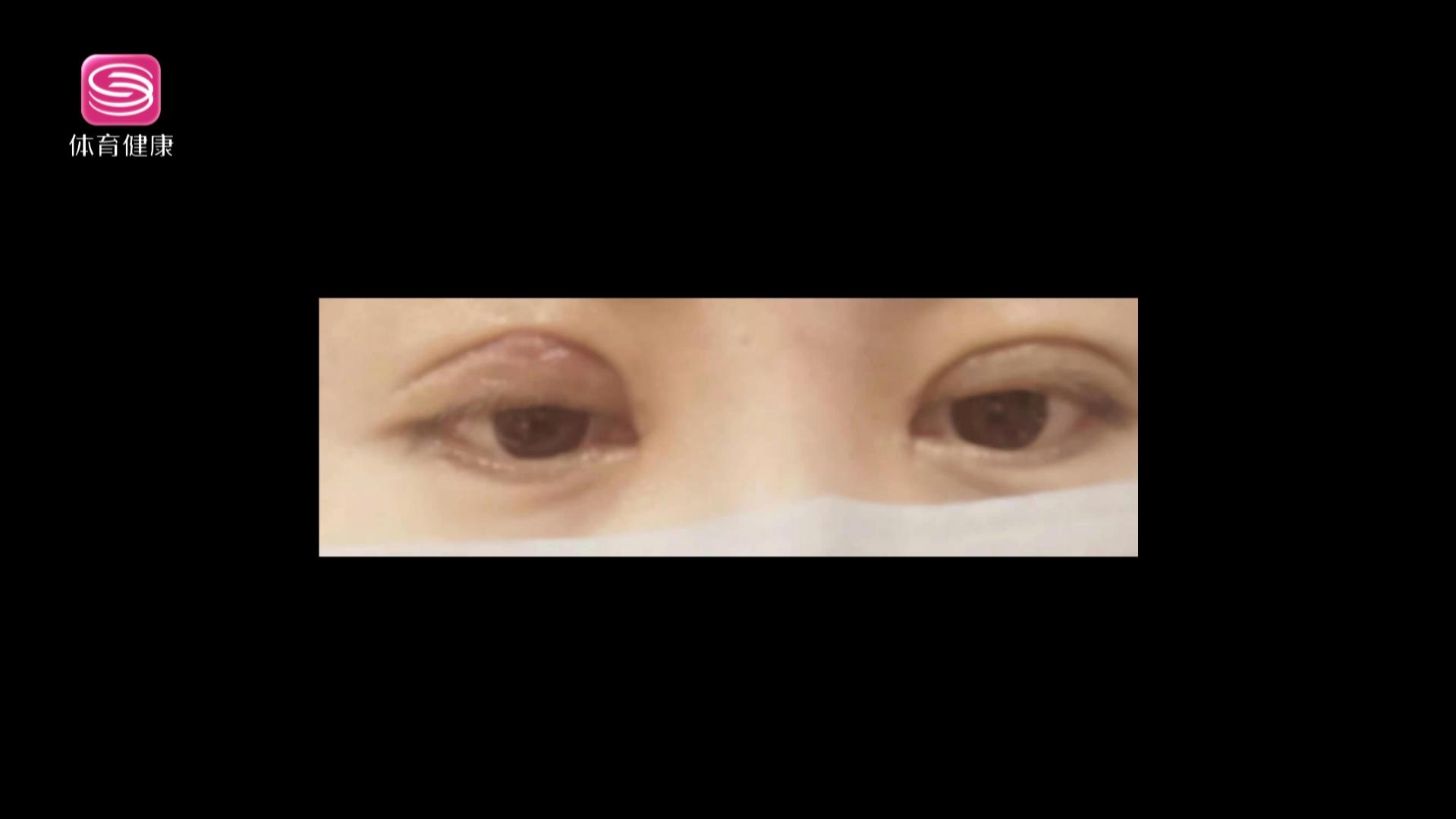 双眼皮手术后眼窝肿了,双眼皮手术后眼窝肿