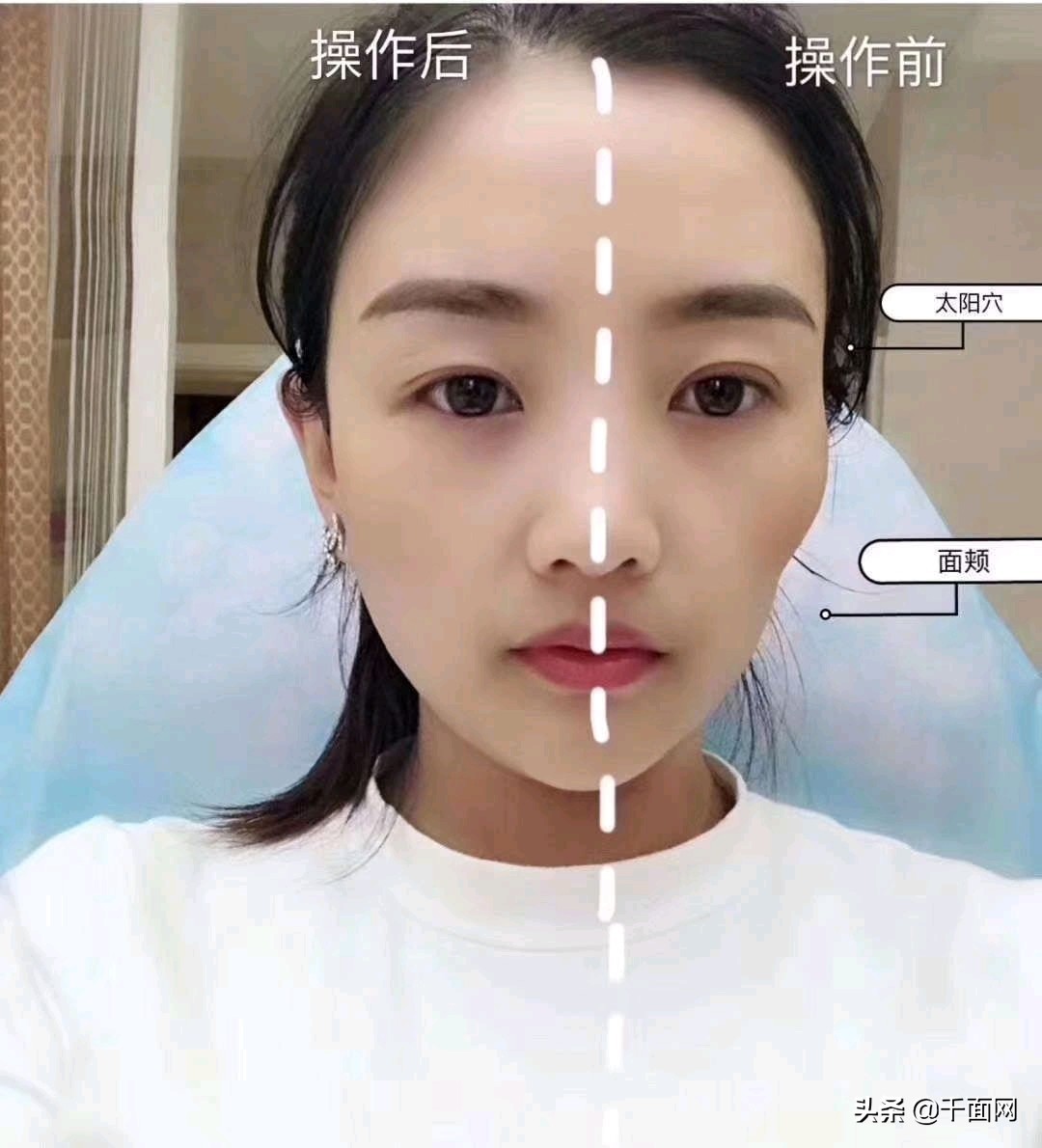 涂抹式太阳穴凹陷填充,40多岁太阳穴凹陷填充