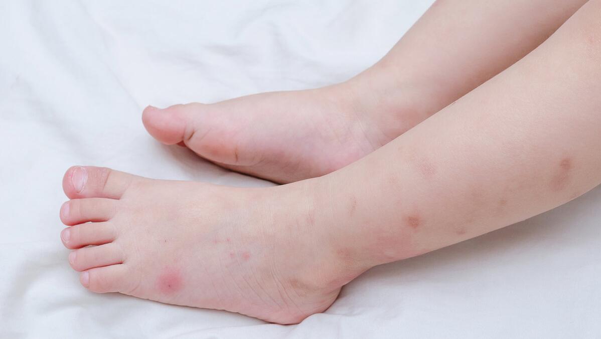 夏天怎么防蚊子咬人,夏天被蚊子咬有办法消灭蚊子