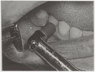 多图直击！牙医如何用抛光把孩子的牙洗干净？#葉子口腔科普#